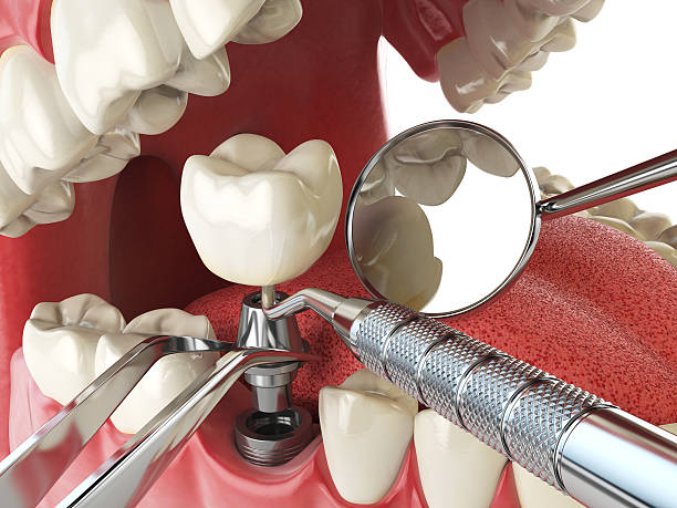 Best Chipped Tooth Repair Near Me  in Greenwood, PA